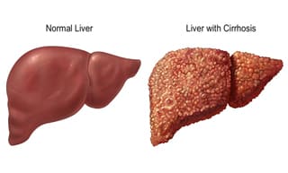 Ayurvedic Treatment for Cirrhosis of Liver